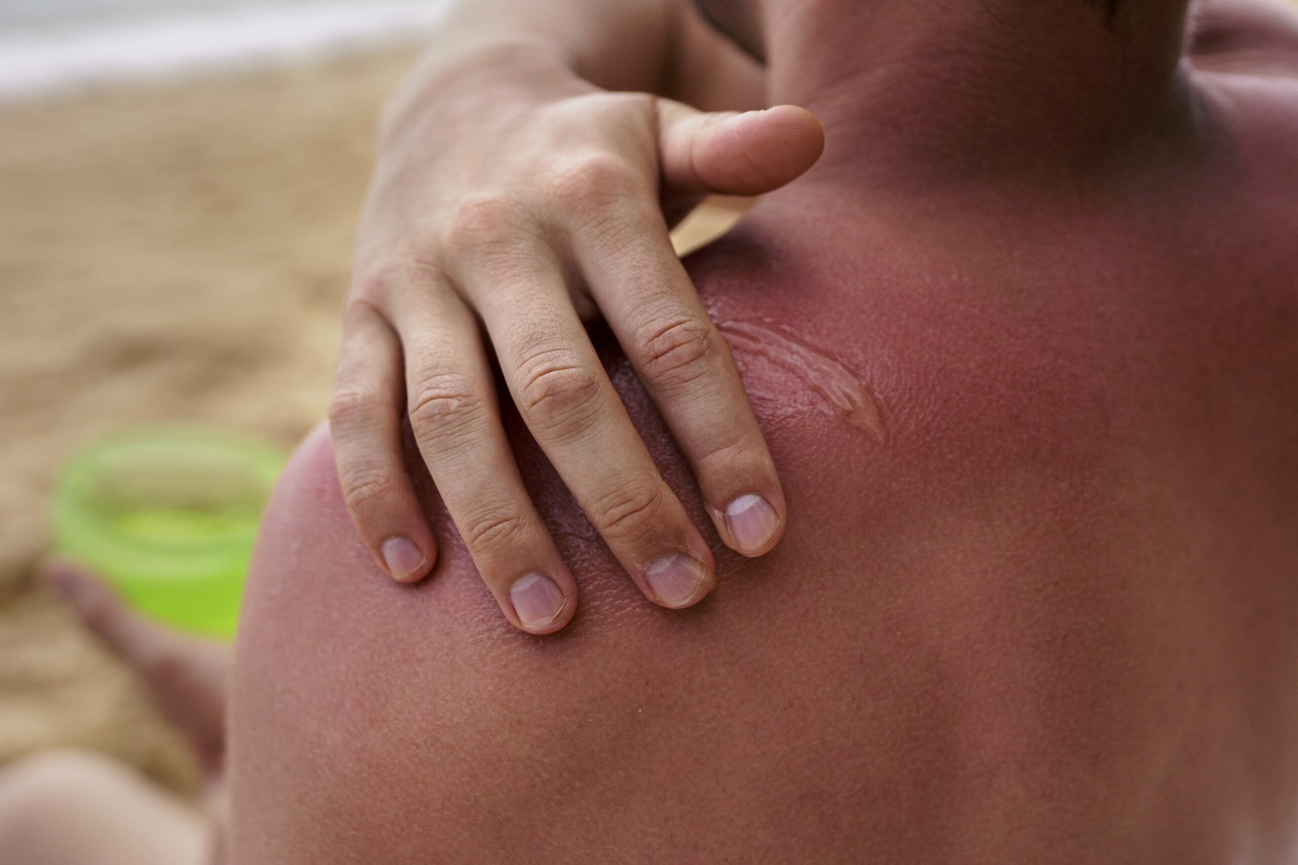red light therapy sunburn